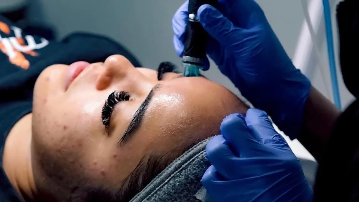 Hydrafacial treatments improve acne